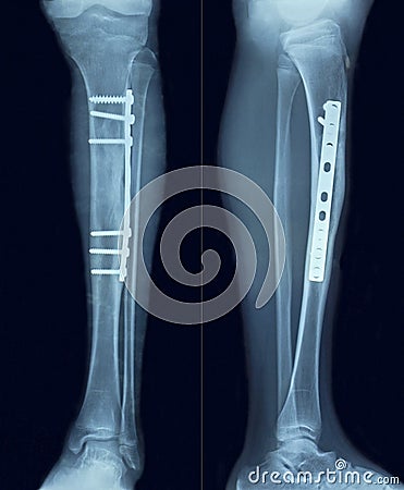 Film x-ray tibia Stock Photo